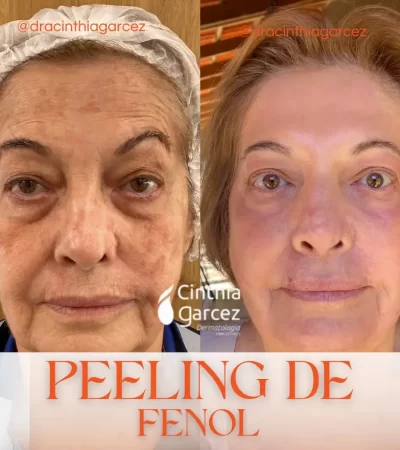 Peeling de Fenol