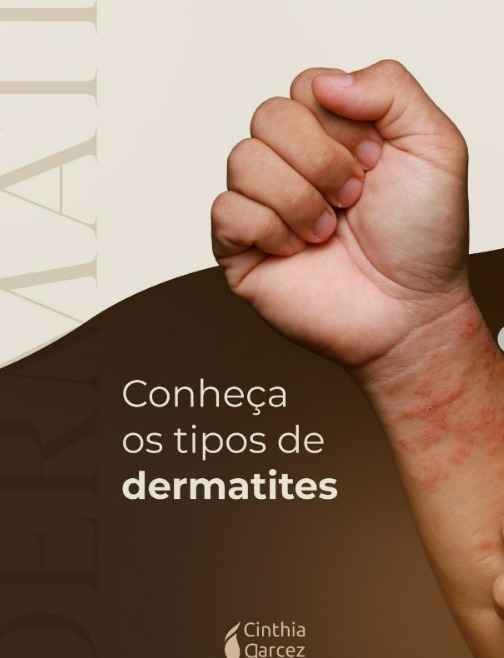 Tipos de dermatite