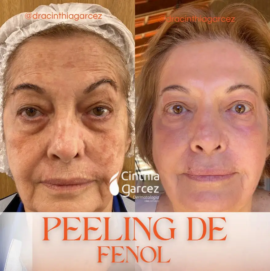 Peeling de Fenol